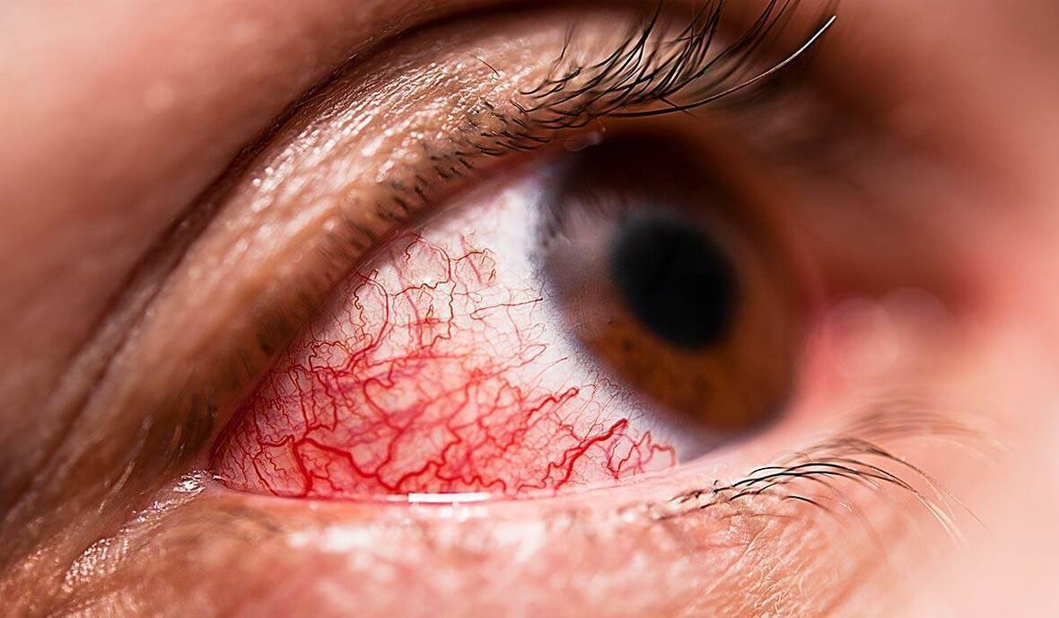 Diabetična retinopatija je eden od poznih zapletov sladkorne bolezni